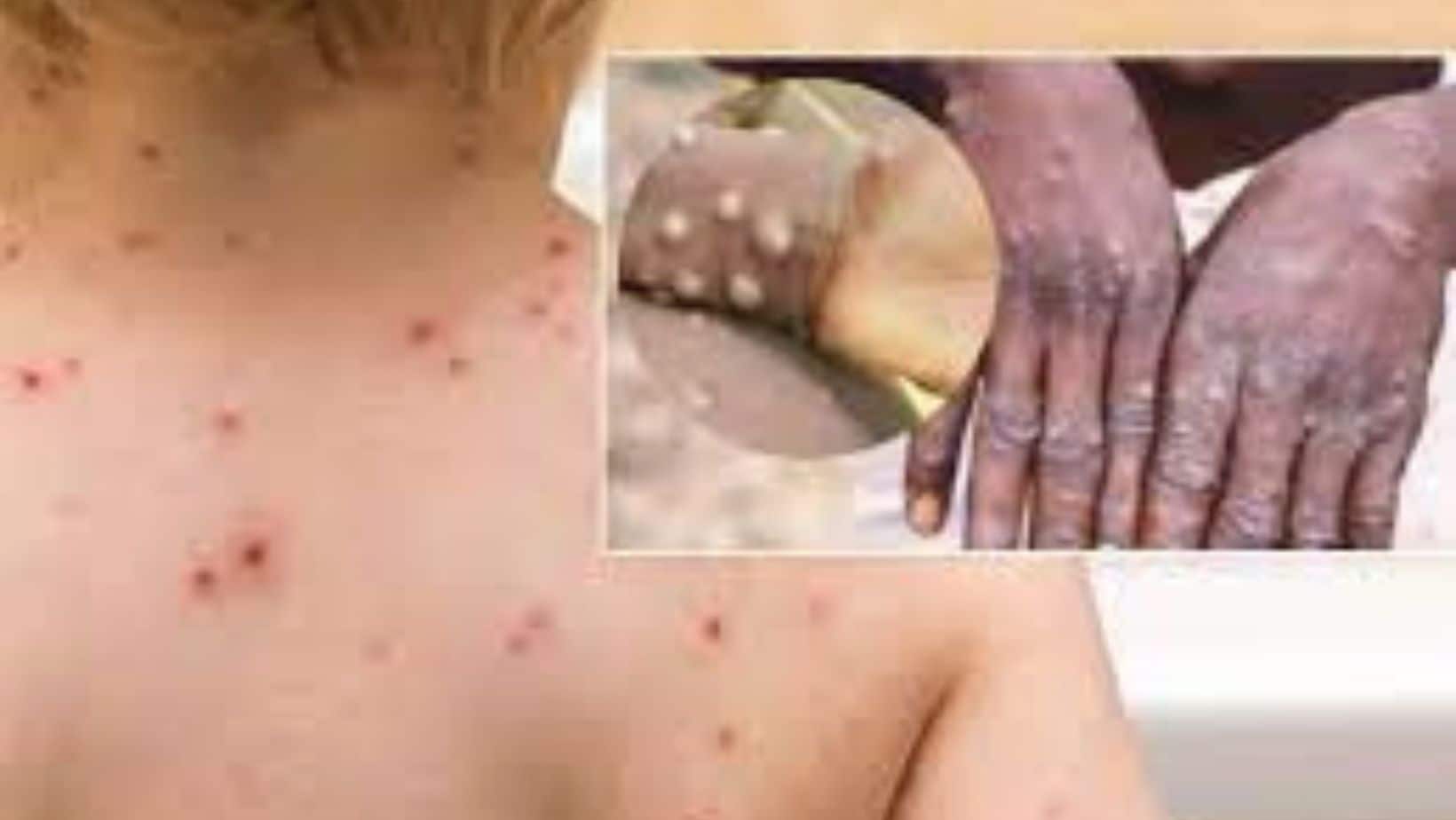 Monkeypox Spreading Rapidly Among Pregnant Women, Children: WHO Warns of Symptoms